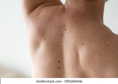 Checking Benign Moles. Close Up Detail Of The Bare Skin On A Man Back With Scattered Moles And Freckles. Pigmentation. Birthmarks On Skin