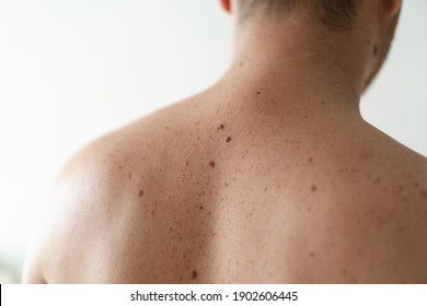 Checking benign moles. Close up detail of the bare skin on a man back with scattered moles and freckles. Pigmentation. Birthmarks on skin