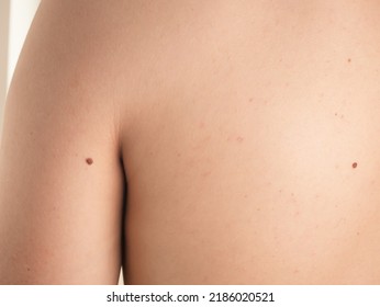 Checking Benign Moles. Close Up Detail Of The Bare Skin On A Man Back With Scattered Moles And Freckles. Pigmentation. Birthmarks On Skin