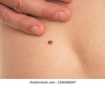 Checking Benign Moles. Close Up Detail Of The Bare Skin On A Man Back With Scattered Moles And Freckles. Pigmentation. Birthmarks On Skin