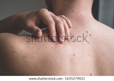 Checking benign moles. Close up detail of the bare skin on a man back with scattered moles and freckles. Sun effect on skin. Pigmentation. Birthmarks on skin