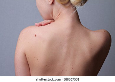 Checking Benign Moles : Woman With  Birthmarks On Her Back . Sun Exposure Effect On Skin, Health Effects Of UV Radiation