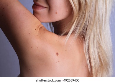 Checking benign moles : Woman with birthmarks on her back and face