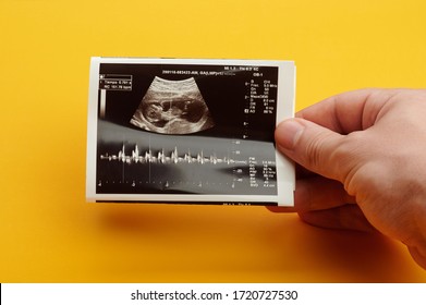 Checking Future Baby Heart Beat Via Ultrasound Check Up