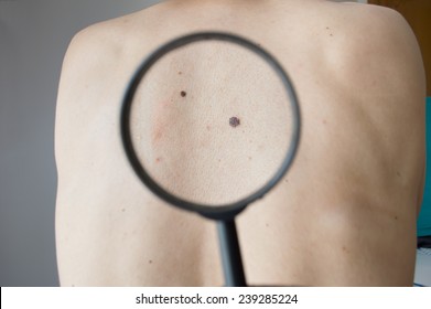 Checking Melanoma On A Back Of A Man With Magnifying Glass