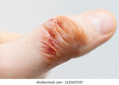 Chemical Burn Finger Household Burn Open Stock Photo 2125637537 ...