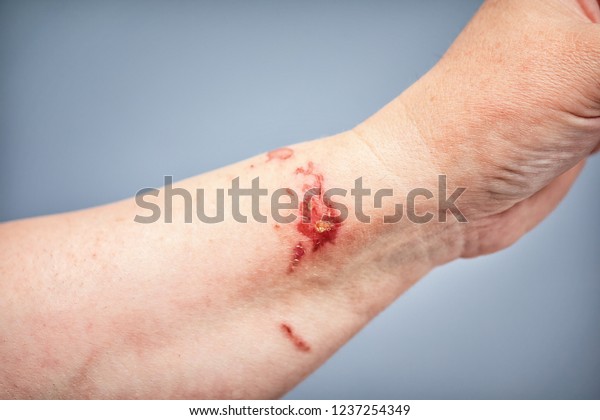 Chemical Burn On Skin Touching Plant Stock Photo (Edit Now) 1237254349