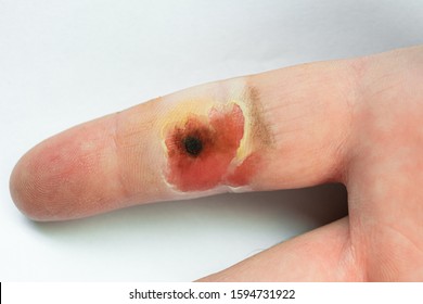Chemical burn on the surface of the human finger. Skin damaged by acids and alkalis. - Shutterstock ID 1594731922
