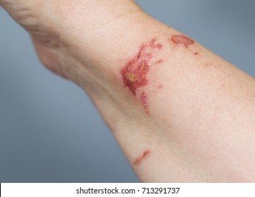 Chemical Burn On Woman Hand.