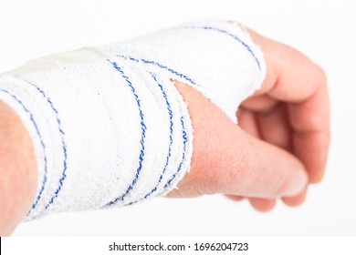 Chemical Burn On Wrist Skin Hydroxide Stock Photo 1696204723 | Shutterstock