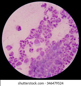 Chemical And Cellular Factors Involved In The Inflammatory Response To Tissue Damage And Repair.white Blood Cells Clumping.