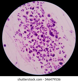 Chemical And Cellular Factors Involved In The Inflammatory Response To Tissue Damage And Repair.white Blood Cells Clumping.