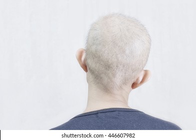Chemotherapy And Hair Loss. Side Effects From Breast Cancer Treatment. [High-key Photo]
