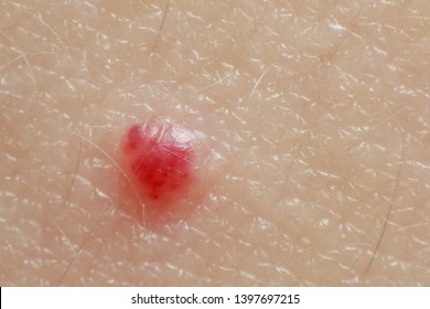 407 Angioma Images, Stock Photos & Vectors | Shutterstock