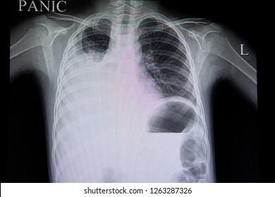 A Chest Film Of A Patient With Dengue Hemorrhagic Fever In Convalescence Phase.  A Right Pleural Effusion Is Demonstrated. Fluid Overload. Fluid Shift In Dengue Fever. Panic Chest X Ray