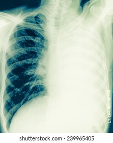 Chest Film View Cavity Right Lung Stock Photo 239965405 | Shutterstock