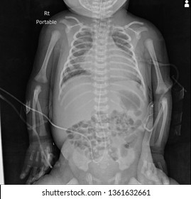 Chest Include Abdomen  X-ray Of The Newborn Who Have Cardiomegaly [Left Ventricular Hypertrophy] Patient Diagnosed As Aortic Stenosis, [umbilical Venous Catheter In Placed]