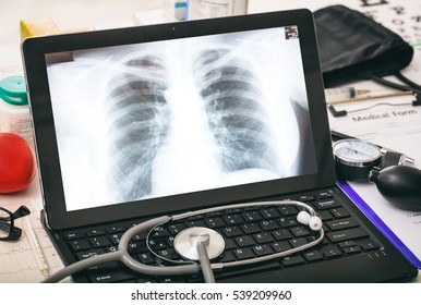 Chest, Lung X Ray On A Doctor's Computer Screen On A Desk