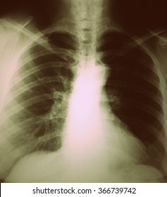 Chest And Lungs Xray Photo