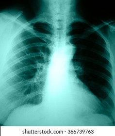 Chest And Lungs Xray Photo