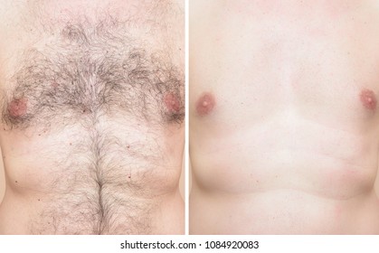 Chest of a man before and after trimming chest hair 