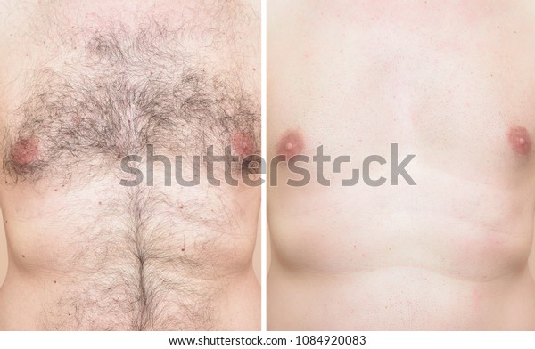 Chest of a\
man before and after trimming chest hair\

