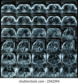 Chest MRI