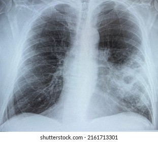 The Chest Radiography Of An Elderly Man Who Has Severe Pneumonia At Left Side Of The Lung. 