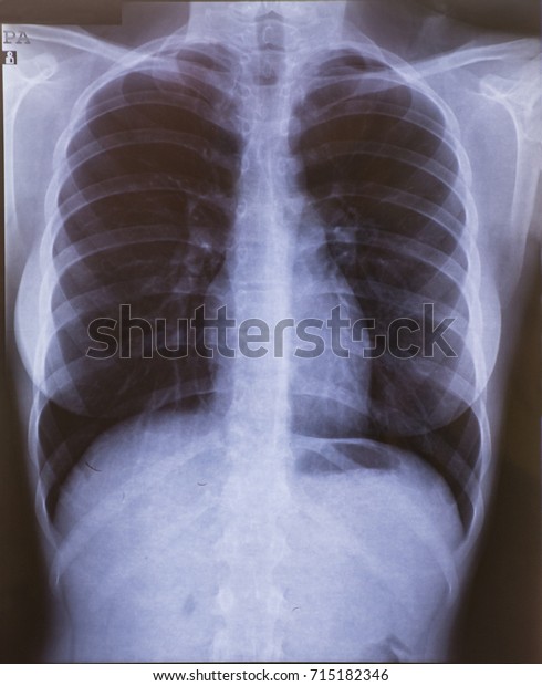 Chest Radiography Woman Stock Photo 715182346 | Shutterstock