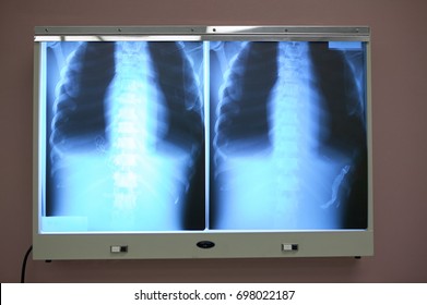 Chest, ribcage and thorax x-ray on a viewing light box in a hospital for the detection of bone fractures or disease in a patient