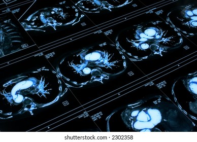 Chest tomogram