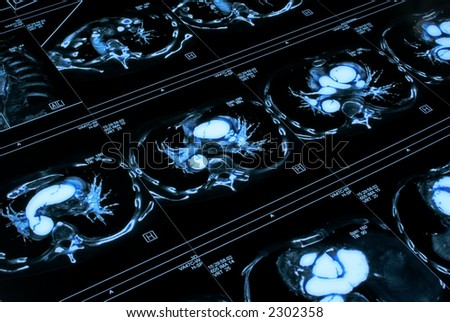 Chest tomogram
