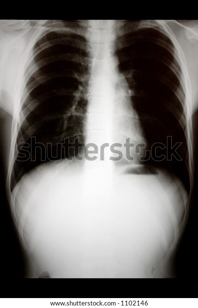 Chest Traditional Radiology Stock Photo 1102146 | Shutterstock