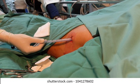 Chest Tube Insertion In Patient With Pneumothorax. Step By Step Procedures 