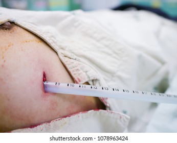 Chest Tube Insertion In Patient With Pneumothorax. Step By Step Procedures