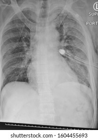 Chest Tube In Place On The Left Lung To Drain Pneumothorax.