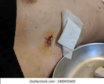 Chest Tube Scar For Patient With Pneumothorax.Removing Stitches After Chest Tube