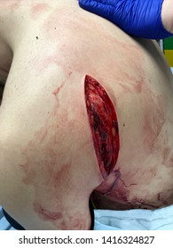 Chest wound from a machete knife attack