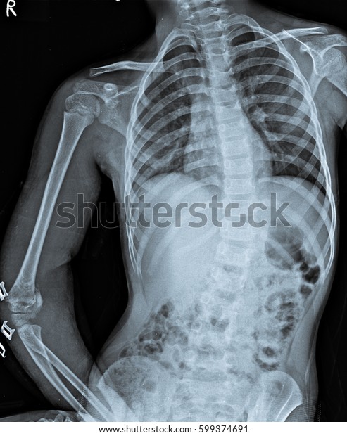 Chest X Ray Abdomen Pelvis Stock Photo 599374691 | Shutterstock