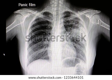A chest x ray film of a patient with left middle lung pneumonia.  Medical Education. Abnormal xray in lung infections. Covid 19 pneumonia.