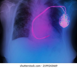 Chest X Ray Image Of  Cardiac Pacemaker 
