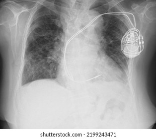 Chest X Ray Image Of  Cardiac Pacemaker 
