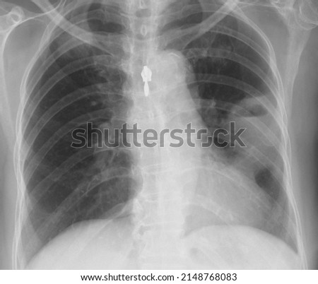 chest x ray image of  lung abscess
the radiographic appearance of a lung abscess in chest x-ray is an irregularly shaped cavity with an air-fluid level.