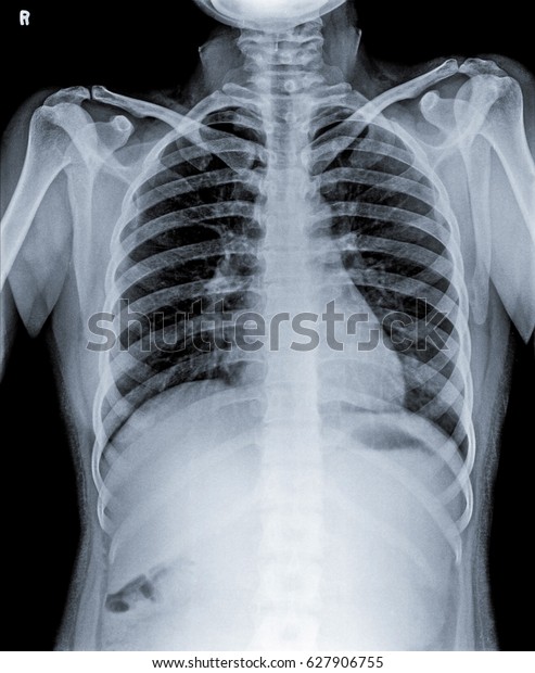 Chest X Ray Normal Person Neck Stock Photo Edit Now 627906755