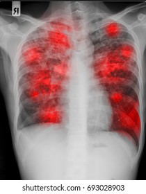 The chest X ray of patient presented with chronic cough who is sicked by disseminated pulmonary tuberculosis from mycobacterium tuberculosis with the red infiltration