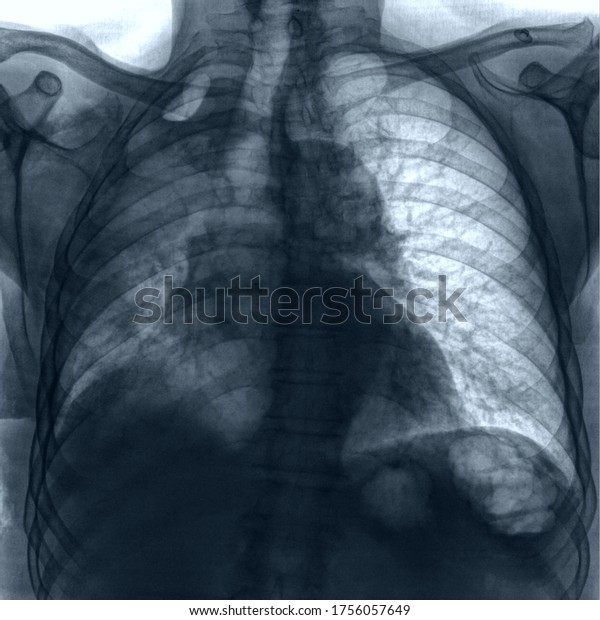 Chest X Ray Pneumonia Atelectasis Right Stock Photo 1756057649 ...