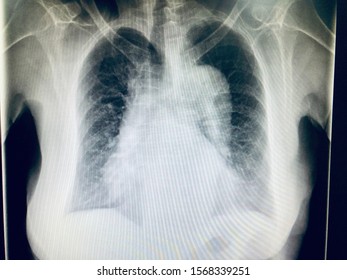 Chest X Ray Thoracic Image Showing Stock Photo (Edit Now) 1568339251