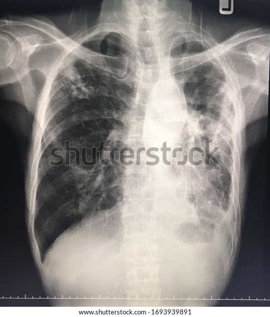 Chest X Rays Show Pulmonary Fibrosis Stock Photo (Edit Now) 1693939891