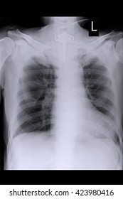 Chest Xray