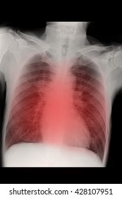 Chest Xray